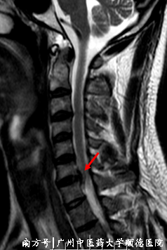 什么是显微镜手术“镜”显神通 精益求精——显微镜下的颈椎手术_https://www.jmylbn.com_新闻资讯_第2张
