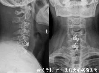 什么是显微镜手术“镜”显神通 精益求精——显微镜下的颈椎手术_https://www.jmylbn.com_新闻资讯_第6张
