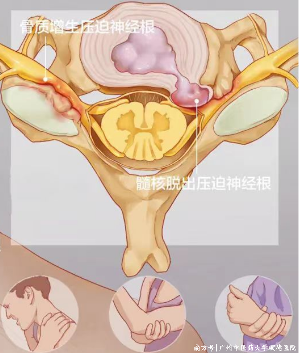什么是显微镜手术“镜”显神通 精益求精——显微镜下的颈椎手术_https://www.jmylbn.com_新闻资讯_第1张