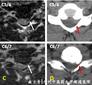 什么是显微镜手术“镜”显神通 精益求精——显微镜下的颈椎手术_https://www.jmylbn.com_新闻资讯_第4张