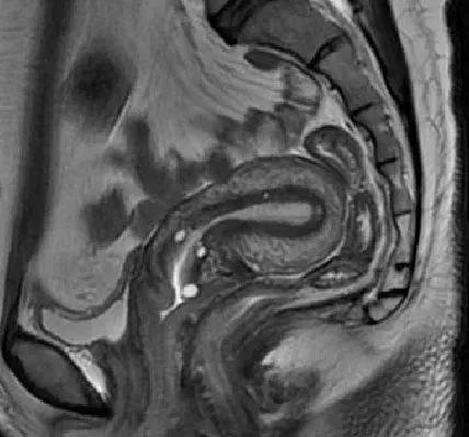 沒有患子宮腺肌癥的子宮，MR圖像顯示子宮壁沒有明顯增厚，層次清晰