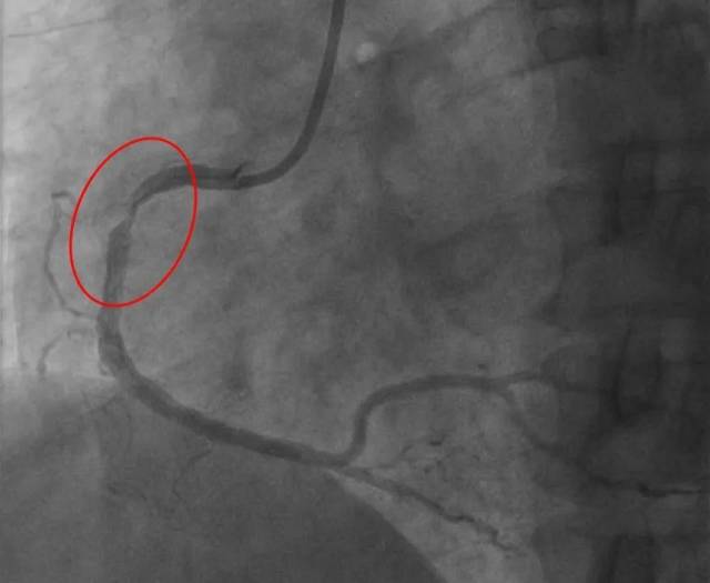紅圈所示右冠狀動脈高度狹窄