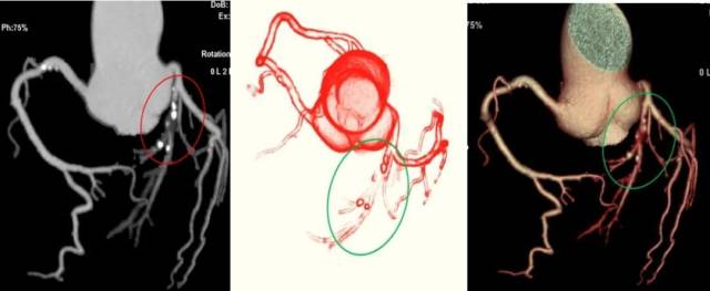 什么仪器可以全身检查超全攻略丨 CTA检查让血管疾病无处遁形！一文让你了解全身各部位的CTA影像！_https://www.jmylbn.com_新闻资讯_第13张