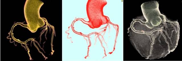 什么仪器可以全身检查超全攻略丨 CTA检查让血管疾病无处遁形！一文让你了解全身各部位的CTA影像！_https://www.jmylbn.com_新闻资讯_第6张