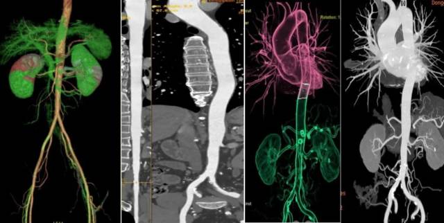 什么仪器可以全身检查超全攻略丨 CTA检查让血管疾病无处遁形！一文让你了解全身各部位的CTA影像！_https://www.jmylbn.com_新闻资讯_第10张