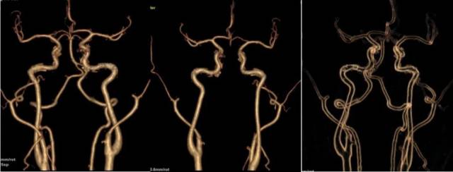 什么仪器可以全身检查超全攻略丨 CTA检查让血管疾病无处遁形！一文让你了解全身各部位的CTA影像！_https://www.jmylbn.com_新闻资讯_第4张