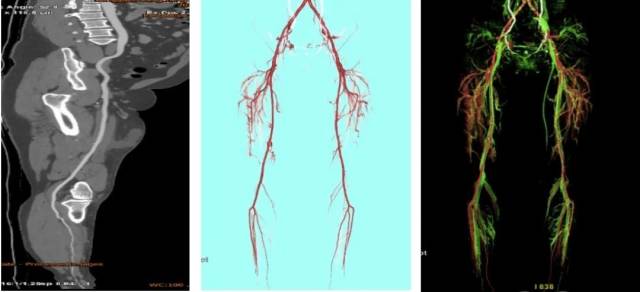 什么仪器可以全身检查超全攻略丨 CTA检查让血管疾病无处遁形！一文让你了解全身各部位的CTA影像！_https://www.jmylbn.com_新闻资讯_第12张
