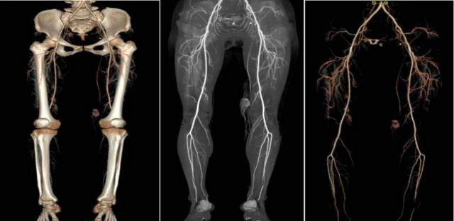 什么仪器可以全身检查超全攻略丨 CTA检查让血管疾病无处遁形！一文让你了解全身各部位的CTA影像！_https://www.jmylbn.com_新闻资讯_第11张