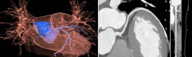 什么仪器可以全身检查超全攻略丨 CTA检查让血管疾病无处遁形！一文让你了解全身各部位的CTA影像！_https://www.jmylbn.com_新闻资讯_第7张