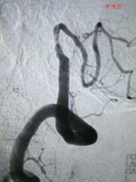 手术后：血管狭窄明显减轻，后续血管血流增加，血管显影清楚