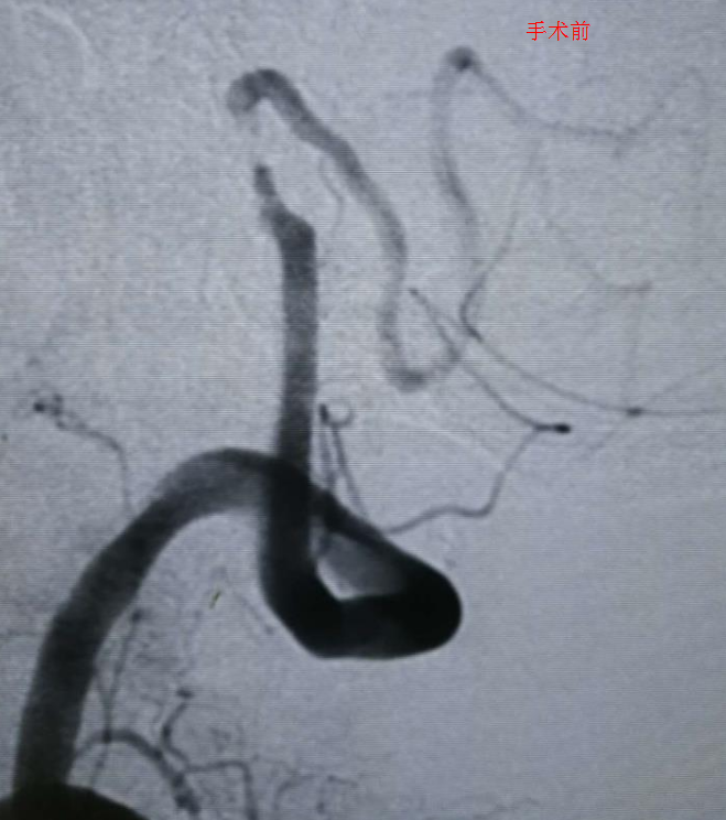 手术前：血管明显狭窄，后续血流显著减少，血管显影不良