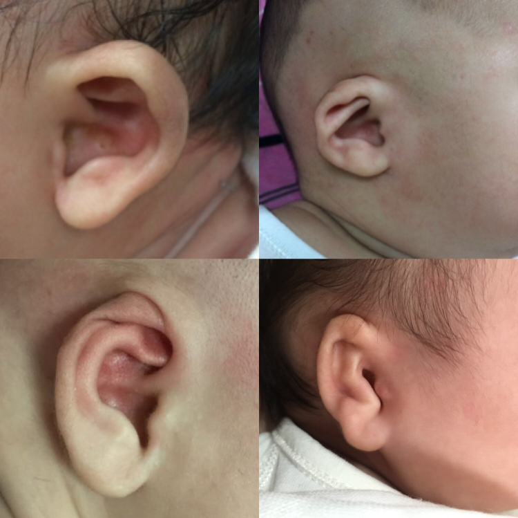 几种常见的耳廓畸形，左上：杯状耳；左下：隐耳；右上：垂耳；右下：结构畸形。