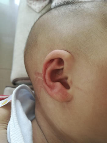 经过19天的矫正后，可可的耳廓形态基本恢复了正常。