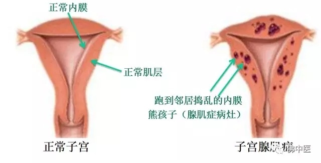 子宫腺肌症解剖图图片