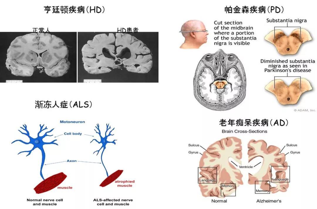 与衰老相关的神经退行性疾病 与衰老相关的神经退行性疾病
