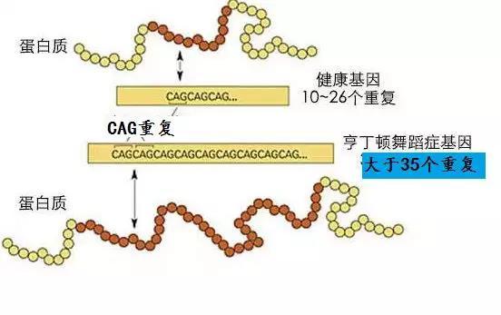 亨廷顿舞蹈症致病机理(来源:网络) 亨廷顿舞蹈症致病机理(来源:网络)