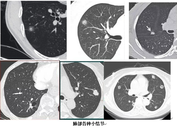  各种肺部小结节