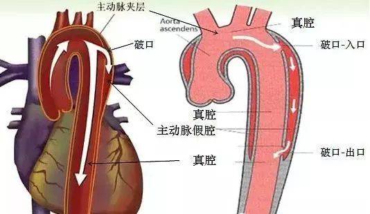 主动脉壁间血肿危险!专家提醒,主动脉直径