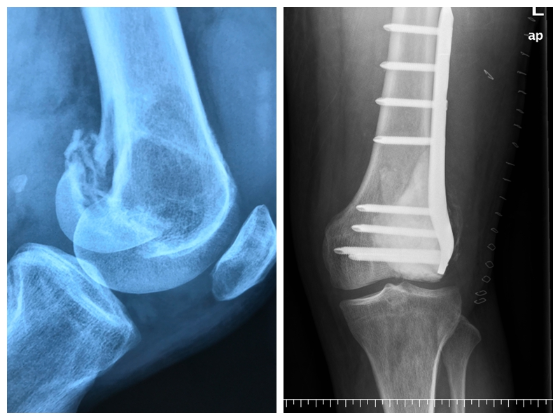 术前术后对比，医生为何先生加固了如薄片一样的骨头
