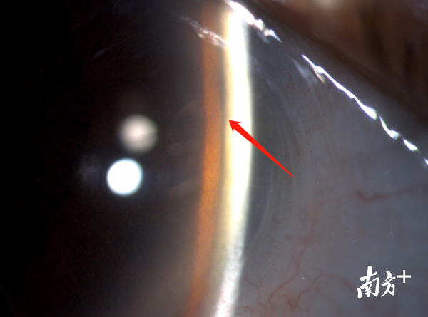 手术前的前房间隙狭窄（光带之间的黑色部分）