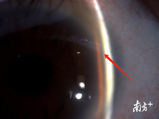手术后的前房间隙明显加深（光带之间的黑色部分）