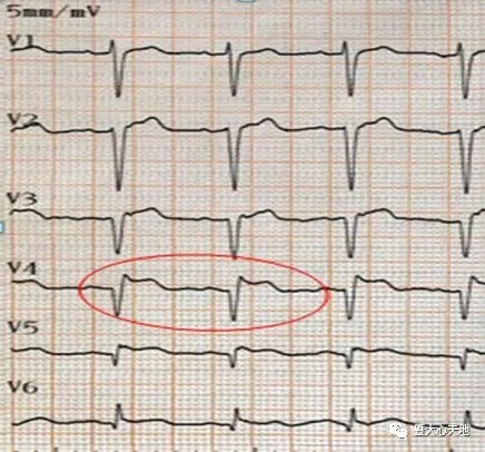 心肌梗死心电图图形图片