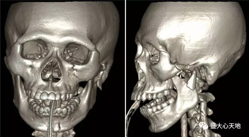 术前严重的面部骨折