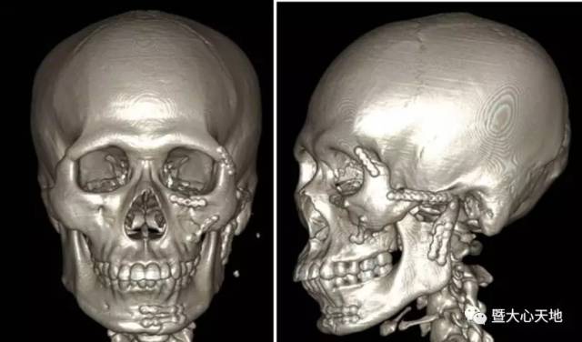 颌面部手术后图片