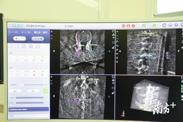 利用三维成像，对手术进行设计，并将方案输入给机器人