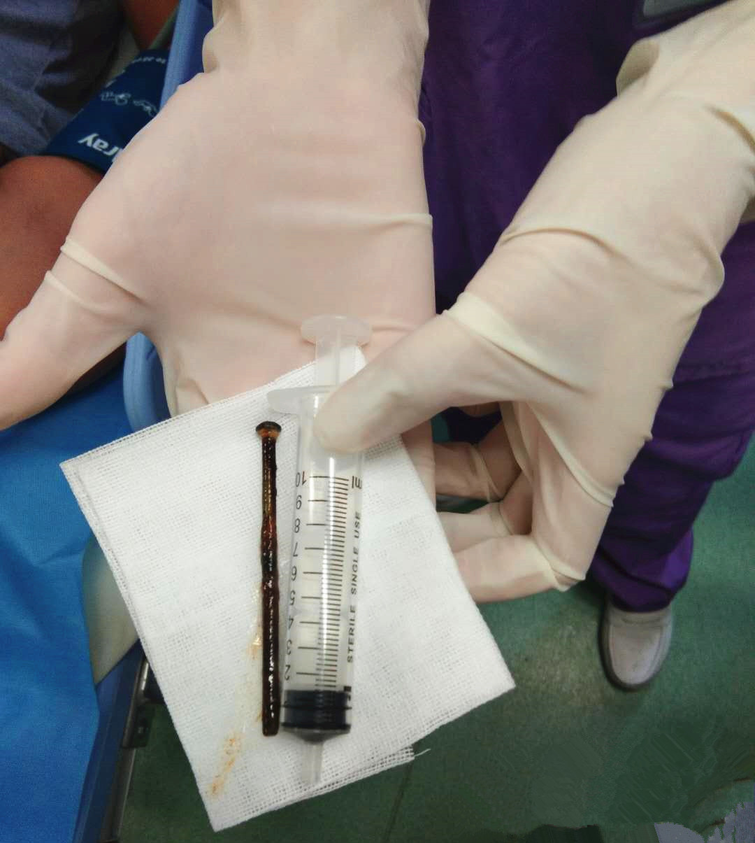 从患者气管内取出的8公分生锈铁钉。