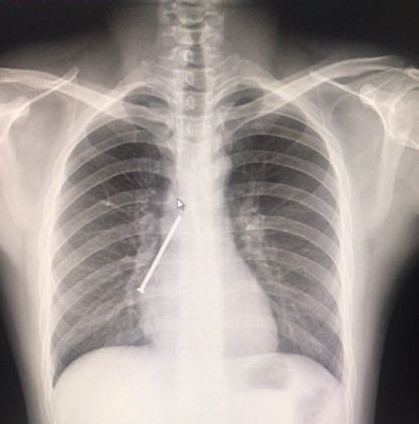 胸片上铁钉清晰可见。