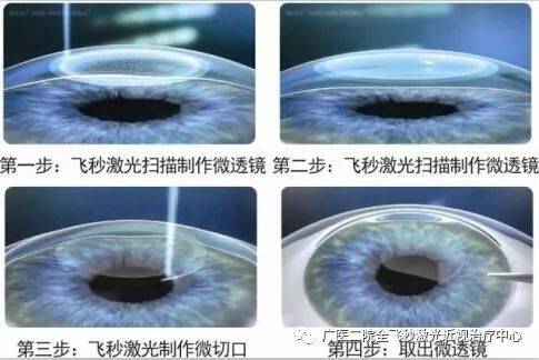 准分子激光近视手术