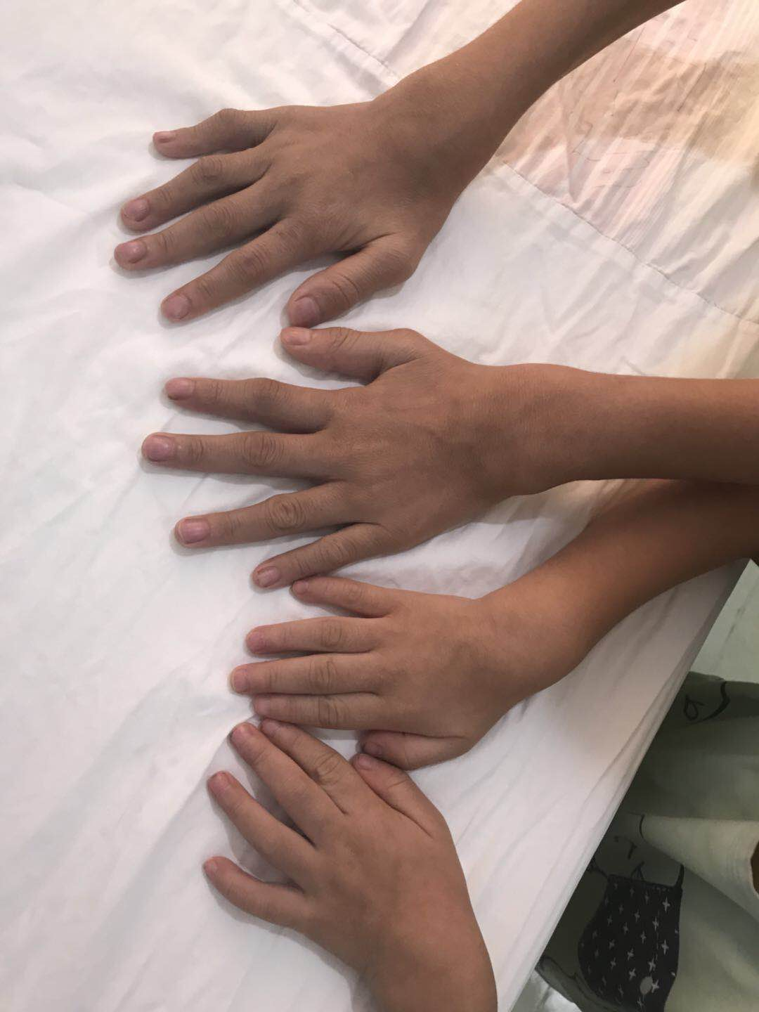 患儿的手腕关节处红肿 患儿的手腕关节处红肿