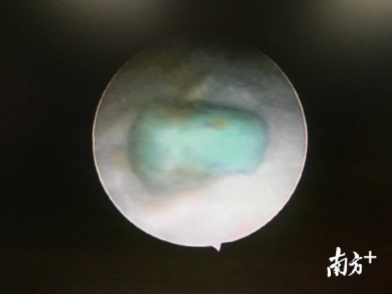 在小夏耳朵中发现了小橡皮