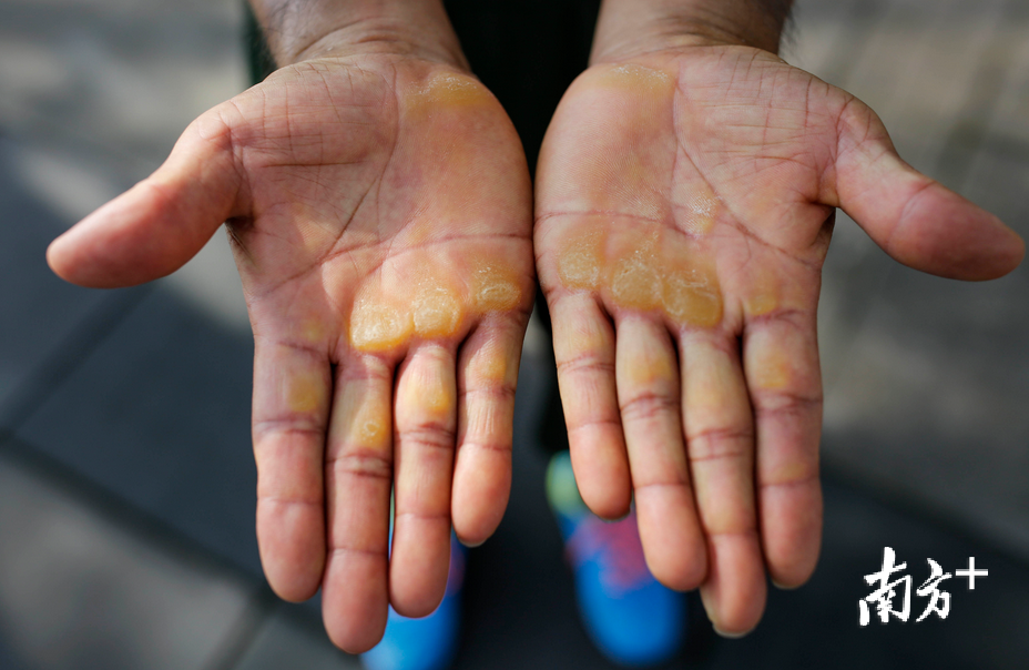 这些年一直在坚持练习单双杠,老臧的手掌上留下厚厚的老茧.