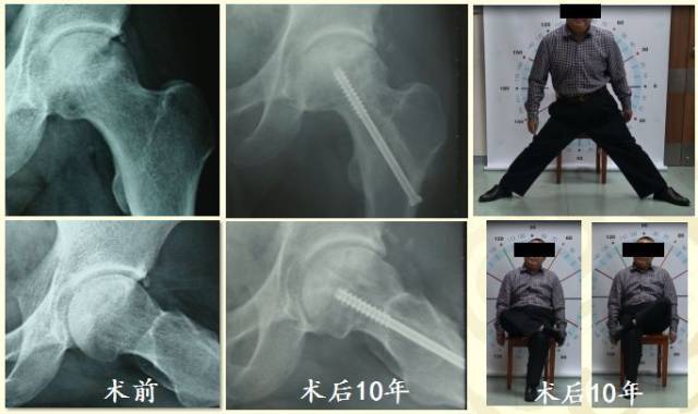 股骨头坏死康复
