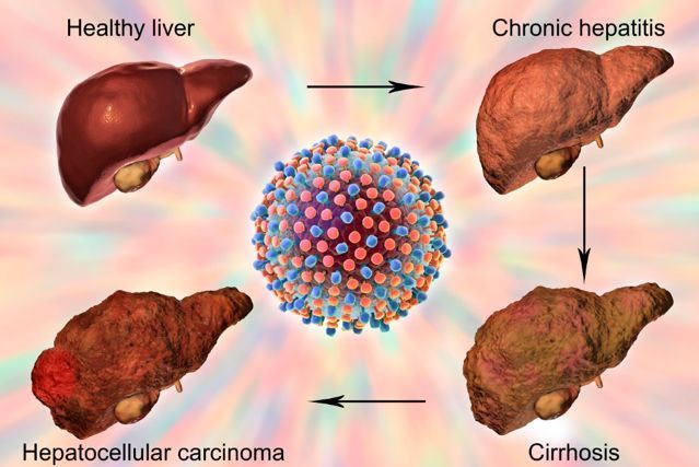 病毒作用下,正常肝脏-慢性肝炎-肝硬化-肝癌