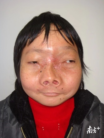 原来,小燕患的是"骨纤维异常增殖症",这是一种骨发育异常疾病,原本