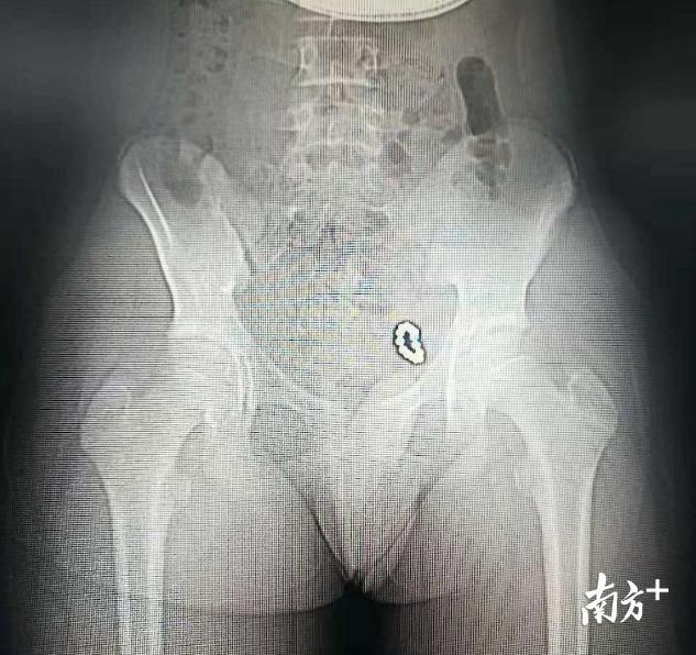 X线片显示下腹部偏左侧有一环形的异物影。