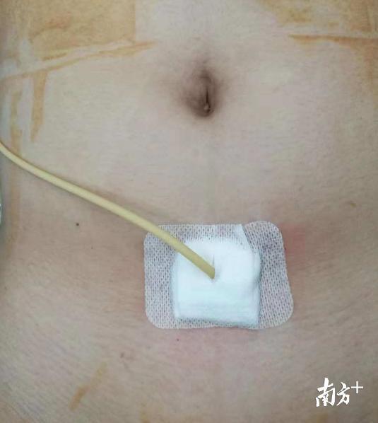 手术仅在孩子的下腹部留下了一个1cm的小切口，图中的黄色管为暂时留置的膀胱造瘘管。