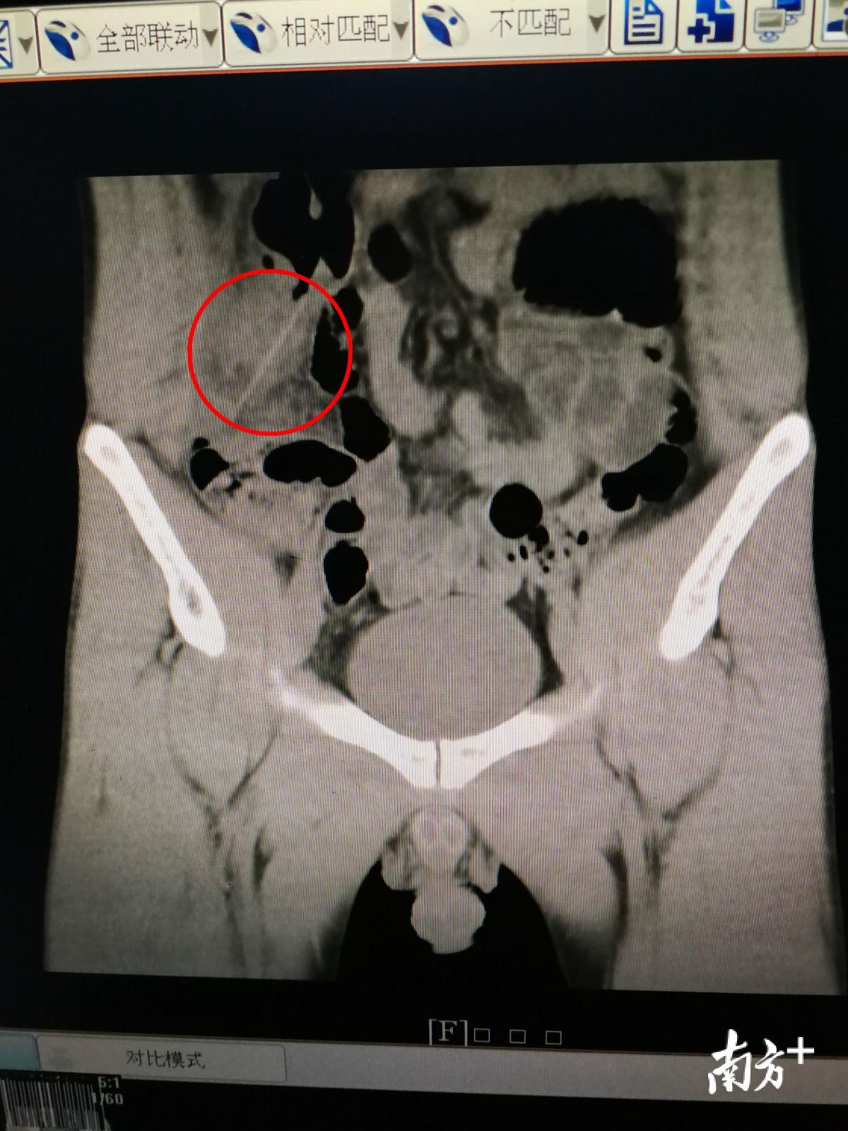 红圈处就是已经刺入结肠的牙签。