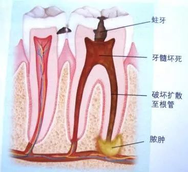 根尖周脓肿，图源来自网络