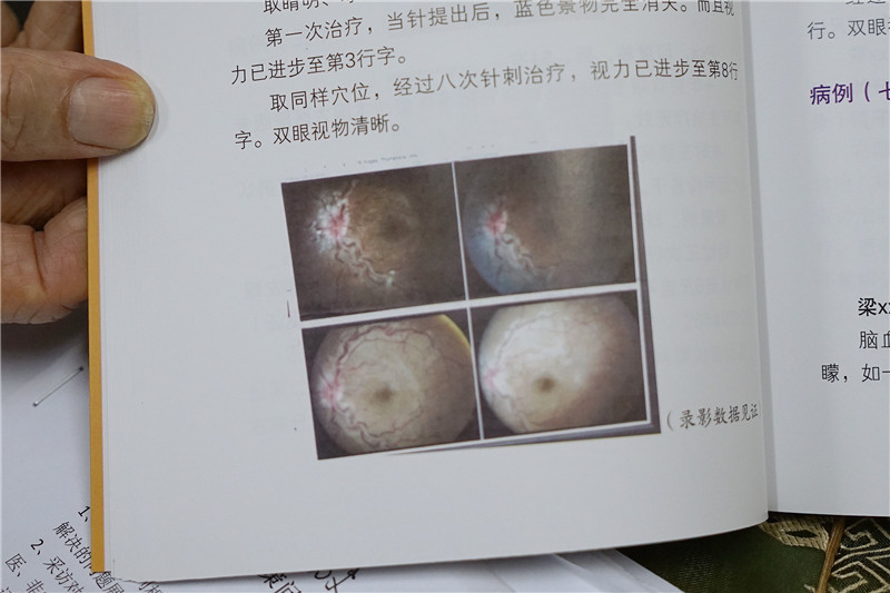 医学影片显示，经过深针疗法，患者的眼球由浑浊到清晰，明显好转。