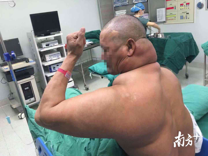包先生的后颈部脂肪瘤有20cm*10cm*8cm大。通讯员供图
