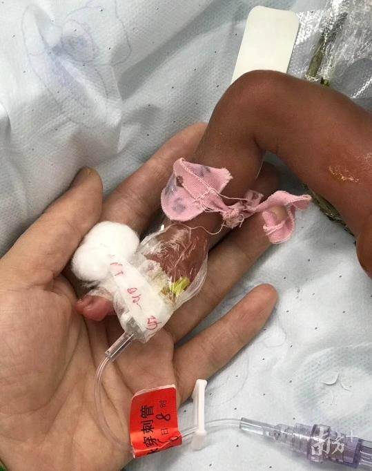 手术中肥肥幼小的腿脚插了很多管子。 手术中肥肥幼小的腿脚插了很多管子。