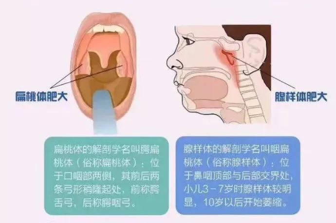 扁桃体、腺样体傻傻分不清楚？看完本文你就明白了！_南方plus_南方+