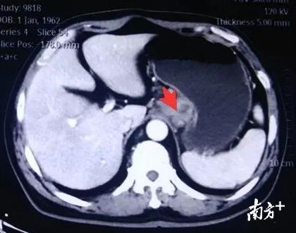 CT提示贲门病变符合恶性肿瘤改变 CT提示贲门病变符合恶性肿瘤改变