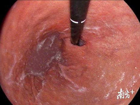 胃镜下达发现贲门巨大溃疡 胃镜下达发现贲门巨大溃疡