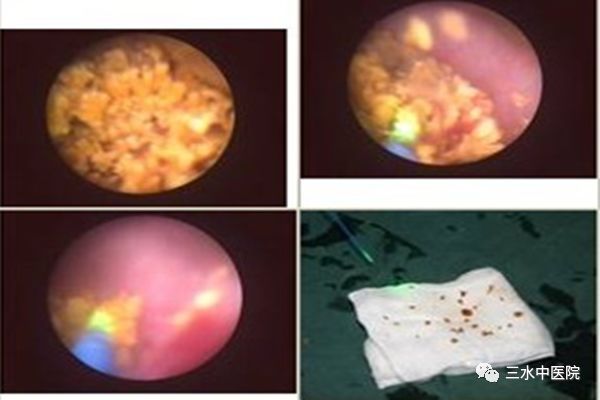 ↑钬激光碎石 ↑钬激光碎石