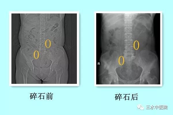 ↑碎石前后对比 ↑碎石前后对比